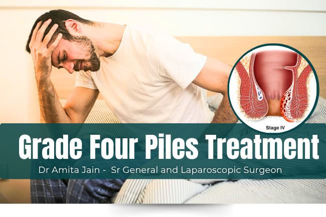 Specialised Treatment for Grade Four Piles or Internal Hemorrhoids Dr Amita Jain